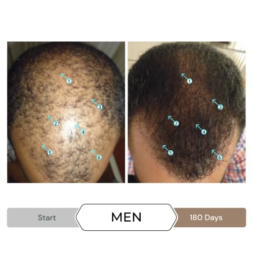 Спектрален.DNC-N Leave В серума за подпомагане на растежа на косата от DS Laboratories - Алтернатива на миноксидилу