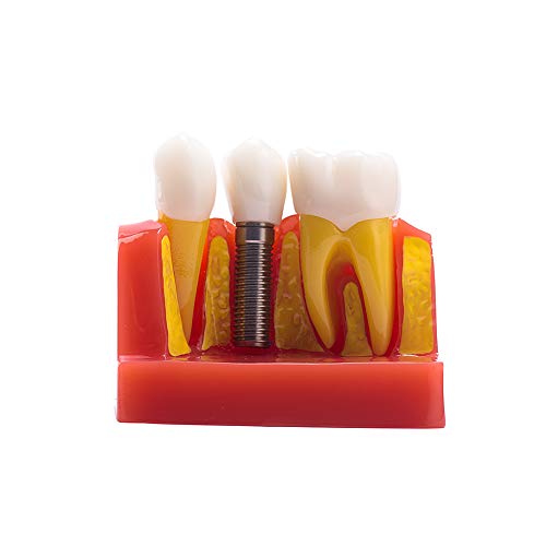 4-Кратна Модел на зъбни импланти, Демонстрационен Модел за Анализ на импланти, Подвижни Корен Корончатого мост (4 пъти)